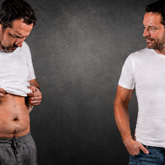 Male tummy tuck