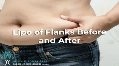 Lipo of Flanks Before and After