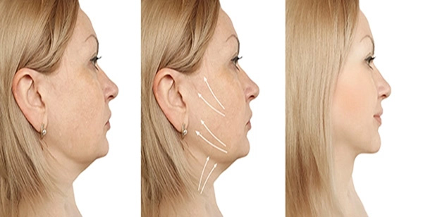 Chin Liposuction Geo City