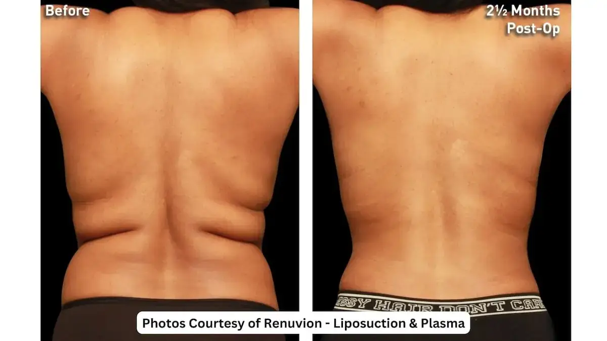 j plasma and liposuction for loose skin in LA, CA