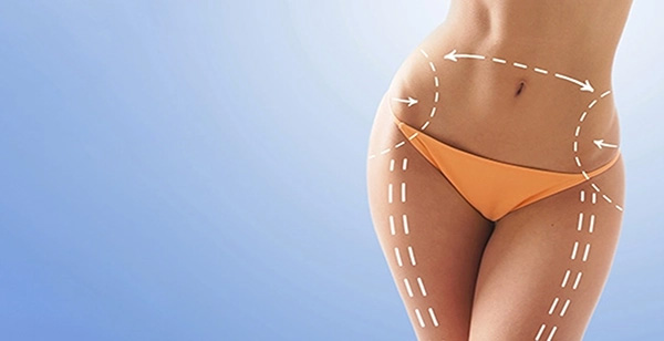 Laser liposuction Geo City A woman in a bikini with arrows on her stomach undergoing liposuction in Geo City.