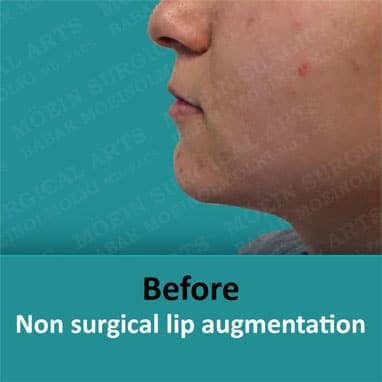 Lip Augmentation Before and After