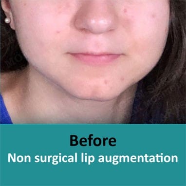 Lip Augmentation Before and After