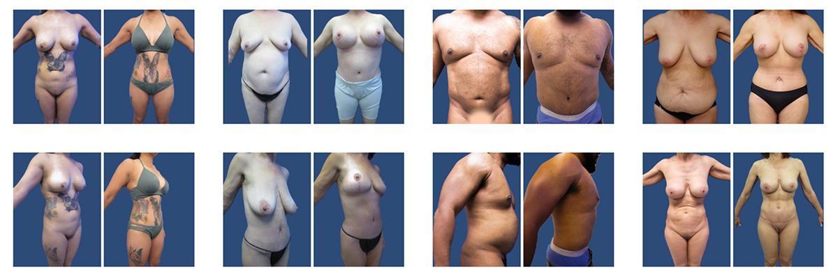 Liposuction before and after Geo City.