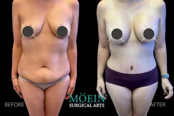 Mommy Makeover Before and After- Dr. Moein in LA, CA