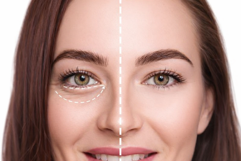 How to Choose the Right Eyelid (Blepharoplasty) Surgeon in Los Angeles?
