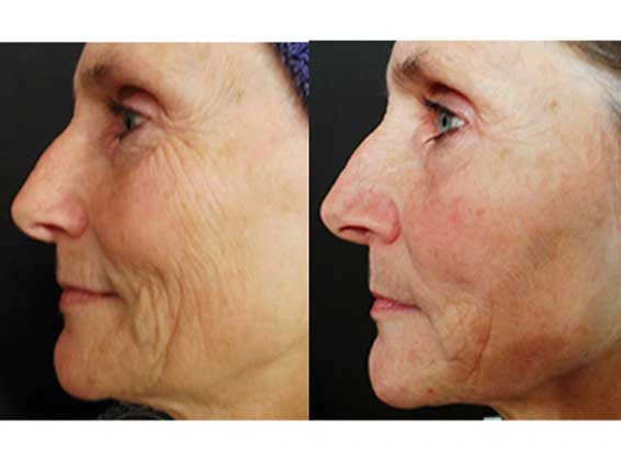 procell results in LA PROCELL MICRONEEDLING in LA