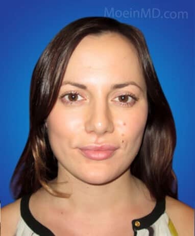 Rhinoplasty before and after