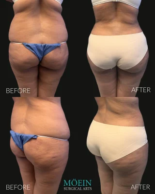 🍑 BBL RESULTS | #BrazilianButtLift
⠀
This patient wanted more than just volume — she wanted shape, contour, and balance.
⠀
A BBL (Brazilian Butt Lift) is about more than transferring fat — it’s an art of sculpting your entire silhouette.
Here’s what it does:
✔️ Removes unwanted fat via liposuction (waist, back, flanks, and other unwanted fat areas)
✔️ Purifies and transfers that fat to the hips and butt
✔️ Enhances your body’s curves for a natural, hourglass result
⠀
BBL isn’t about looking overdone — it’s about harmonizing your frame and bringing out your best proportions.
⠀
Ready to reshape your body with real, natural-looking results?
📲 DM us
📞 Call us (310) 861-4093
🌐 visit www.moeinsurgicalarts.com
📧 Appointment@msurgicalarts.com