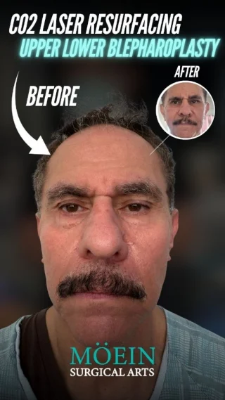 ✨ Total Eye & Skin Rejuvenation ✨

This stunning transformation combines upper & lower blepharoplasty with CO2 laser resurfacing for brighter eyes, smoother skin, and a youthful glow.

Ready for your refresh?

📲 DM us 
 📞 (310) 861-4093 
🌐 www.moeinsurgicalarts.com

#Blepharoplasty #CO2Laser #FacialRejuvenation #YouthfulLook #DrMoein #BeverlyHills