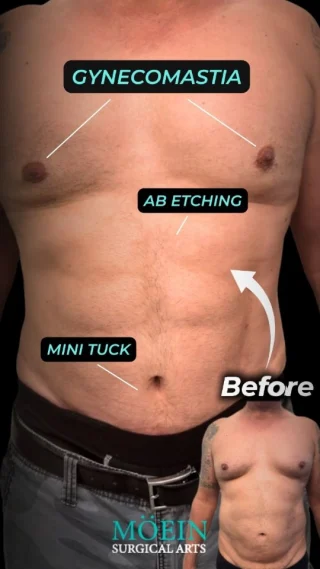 The Glow-Up is Real 💪🔥

🔙 BEFORE:
▪️ Enlarged male chest (gynecomastia)
▪️ Lack of abdominal definition
▪️ Loose lower belly skin

✨ AFTER:
🔹 Masculine, contoured chest
🔹 Sculpted six-pack abs from Ab Etching
🔹 Firmer, tighter lower abdomen with a Mini Tuck

This transformation redefines confidence. Say goodbye to insecurity—and hello to a new you.

📲 DM us to book your consultation
📞 (310) 861-3176
🌐 moeinsurgicalarts.com
📧 appointment@msurgicalarts.com

#DrMoein #GynecomastiaSurgery #AbEtching #MiniTuck #MaleBodyContouring #ConfidenceRebuilt #MoeinSurgicalArts #moeinsurgialarts