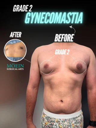 Grade 2 Gynecomastia Surgery Transformation 💪✨

Say hello to this remarkable chest transformation! With the help of advanced Grade 2 Gynecomastia Surgery, this patient achieved a flatter, firmer, and more masculine chest contour—restoring confidence and comfort in their own skin.

💡 Why This Surgery Makes a Big Difference:

✔️ Removes excess glandular tissue & fat for a smooth, natural-looking chest.
✔️ Improves chest shape and definition, eliminating puffiness and bulging.
✔️ Restores symmetry for a balanced, athletic appearance.

The result? A sculpted, confident look that makes wearing fitted shirts—and even going shirtless—something to look forward to. 💪

Are you struggling with excess chest tissue or looking for a permanent solution to gynecomastia? Let us help you achieve the chest you’ve always wanted.

📲 DM us
📞 Call us (310) 861-4093
🌐 Visit moeinsurgicalarts.com
•
•
•
#GynecomastiaSurgery #MaleChestSurgery #BeforeAndAfter #ChestTransformation #ConfidenceRestored #drmoein #beverlyhills #moeinsurgicalarts #MensHealth #bodyconfidence
