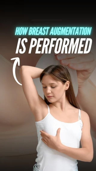 How Breast Augmentation Is Performed?

In this detailed 3D video, I’ll guide you through each step of the procedure — from planning your perfect size and shape to placing the implants for natural, beautiful results. 💎

📹 You’ll see:
How we mark and prepare the surgical area
Where the discreet incision is made
How the implant is placed — either above or below the muscle
How everything is closed for minimal scarring and maximum symmetry

📲 DM us “AUGMENT” to learn more or book your consultation.

Breast augmentation is typically performed under general anesthesia and can use silicone or saline implants, or your own fat for a natural enhancement. With precise planning and careful technique, we create results that fit your body and your vision.

#DrMoein #BreastAugmentation #BreastImplants #CosmeticSurgery #3DSurgery
