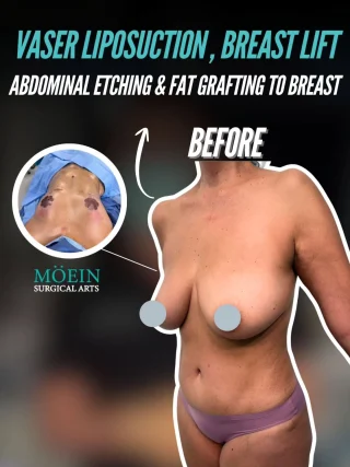 Vaser Liposuction, Breast Lift, Abdominal Etching & Fat Grafting To Breast Results ✨

Say hello to this amazing transformation! With a combination of Vaser Liposuction with abdominal etching to sculpt the midsection and a breast lift with fat grafting to enhance the bust, this patient achieved a sculpted, defined, and beautifully contoured new physique.

💡 What Makes This Combo Powerful:
✔️ Vaser Liposuction & Abdominal Etching removes unwanted fat with precision and enhances underlying muscle definition for a toned, athletic appearance.
✔️ A Breast Lift with Fat Grafting raises and reshapes the breasts for a more youthful profile while using the patient's own fat to restore natural volume and shape.

The result? A beautifully defined abdomen, lifted, fuller breasts, and a completely revitalized silhouette for a major boost in confidence!

Are you interested in Vaser liposuction, a breast lift, abdominal etching, or body contouring? Contact us today!

📲 DM us
📞 Call us (310) 861-4093
🌐 Visit www.moeinsurgicalarts.com
•
•
•
#VaserLipo #Liposuction #BreastLift #Mastopexy #AbdominalEtching #FatGrafting #BodyContouring #BodySculpting #drmoein #beverlyhills #BeforeAndAfter
