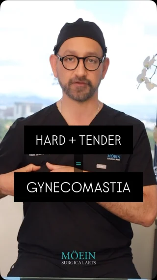 1 in 3 men will experience gynecomastia in their lifetime, the development of excess breast tissue that often causes embarrassment, discomfort, and insecurity.

Whether it’s due to hormones, genetics, or medication, you are not alone, and more importantly, you are not stuck with it.

Gynecomastia surgery is one of the most effective solutions for restoring a flatter, firmer, and more masculine chest. Treatment typically includes:
• Gland removal to target dense tissue behind the nipple
• Liposuction to remove surrounding fat and sculpt definition
• Minimal scarring techniques for natural-looking results

The outcome?
A more athletic, confident appearance — and freedom from compression shirts, oversized tees, and body anxiety at the pool or gym.

Stop hiding your chest. Start feeling like yourself again.

📲 DM us to book your own transformation 
🌐 visit www.moeinsurgicalarts.com
📧 Appointment@msurgicalarts.com
•
•
#Gynecomastia #MaleChestSurgery