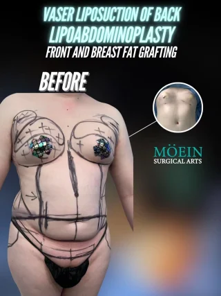 Vaser Liposuction Of Back, Lipoabdominoplasty & Breast Fat Grafting Results ✨

Say hello to this stunning transformation! With a combination of Vaser Liposuction of the back to contour the upper and lower back, a Lipoabdominoplasty to flatten and tighten the front, and Breast Fat Grafting to naturally enhance the bust, this patient achieved a beautifully sculpted and youthful silhouette.

💡 What Makes This Combo Powerful:
✔️ Vaser Liposuction of Back removes stubborn fat deposits and defines the back for a smooth, contoured shape.
✔️ Lipoabdominoplasty combines liposuction with a tummy tuck to sculpt, tighten, and tone the midsection for a flatter, firmer front.
✔️ Breast Fat Grafting uses the patient’s own fat to restore volume, enhance shape, and create a fuller, more natural bust.

The result? A contoured back, a toned and defined abdomen, and naturally fuller breasts – all coming together for a confident, revitalized new look!

Are you interested in Vaser liposuction, lipoabdominoplasty, breast fat grafting, or body contouring? Contact us today!

📲 DM us
📞 Call us (310) 861-4093
🌐 Visit www.moeinsurgicalarts.com
•
•
•
#VaserLipo #BackLipo #Lipoabdominoplasty #FatGrafting #BodyContouring #BodySculpting #drmoein #BeverlyHills #BeforeAndAfter