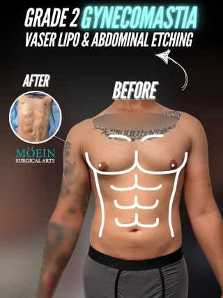 Grade 2 Gynecomastia, Vaser Lipo & Abdominal Etching Results ✨

Check out this powerful masculine transformation! With a combination of Vaser Liposuction to treat Grade 2 Gynecomastia for a flatter chest and Abdominal Etching to sculpt the core, this patient achieved a chiseled and defined physique.

💡 What Makes This Combo Powerful:
✔️ Vaser for Gynecomastia removes excess fat and glandular tissue, correcting puffiness and creating a firm, masculine chest contour.
✔️ Vaser Lipo & Abdominal Etching precisely removes stubborn fat to reveal and enhance the definition of the abdominal muscles for a "six-pack" look.

The result? A confident new outlook with a defined, athletic torso – combining a sculpted chest with a chiseled midsection for a complete transformation!

Are you interested in gynecomastia treatment, Vaser liposuction, abdominal etching, or male body sculpting? Contact us today!

📲 DM us
📞 Call us (310) 861-4093
🌐 Visit www.moeinsurgicalarts.com
•
•
•
#Gynecomastia #grade2gynecomastia #VaserLipo #AbdominalEtching #MaleBodySculpting #BodyContouring #GynecomastiaSurgery #drmoein #BeverlyHills #BeforeAndAfter