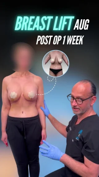Breast Lift + Augmentation: 1 Week Post-Op ✨

Dr. Moein proudly shares the beautiful early results of his patient just one week after surgery — combining a breast lift with augmentation for a youthful, natural, and fuller look. 💖

🌟 What you can see even this early on:
 ✅ Restored breast shape and symmetry
 ✅ Fuller, lifted appearance with implants
 ✅ Natural contour that enhances overall body proportions

This is just the beginning! Healing has only started, and the results will continue to refine beautifully over time.

👨‍⚕️ At Moein Surgical Arts, our goal is to deliver natural-looking, confidence-boosting transformations with expert care from consultation through recovery.

📲 DM us to learn more about breast lift with augmentation
 📞 Call us: (310) 861-4093
 🌐 Visit: www.moeinsurgicalarts.com
 📧 Email: Appointment@msurgicalarts.com

#BreastLift #BreastAugmentation #PostOpJourney #DrMoein #MoeinSurgicalArts #NaturalResults #ConfidenceBoost #PlasticSurgery