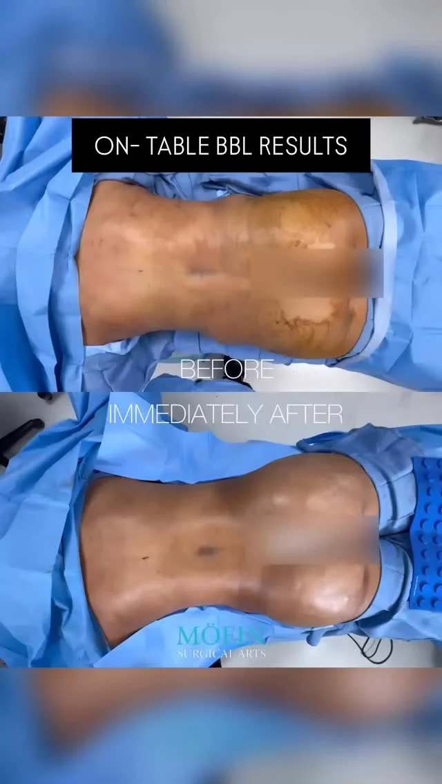 Waist? Snatched. 🍑 Booty? Elevated. 🔥 

Watch these Brazilian Butt lift (BBL) results up close—because the details matter.

✨ What a BBL does for you:
✅ Shapes & enhances your natural curves
✅ Cinches the waist for that perfect hourglass look
✅ Uses your own fat—no implants, just you but better

When the waist goes in and the curves come out… it’s a whole new vibe. 💃 Who’s ready for their glow-up? Contact us for a consultation today!
📲 DM us
🌐 visit www.moeinsurgicalarts.com
📧 Appointment@msurgicalarts.com
•
•
#BBL #SnatchedWaist #CurvesForDays #DrMoein
