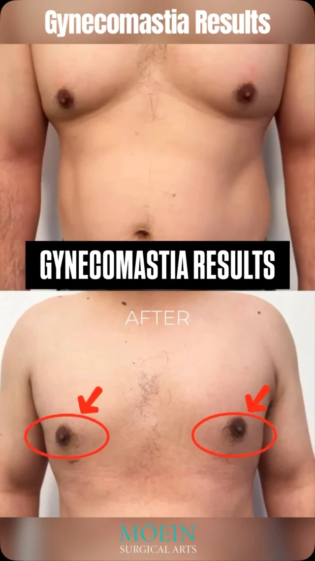 Goodbye to “man boobs.” Hello to confidence.

This gynecomastia transformation is more than cosmetic, it’s a reclaiming of confidence, posture, and presence.

Whether caused by hormones, genetics, or weight fluctuations, gynecomastia affects up to 1 in 3 men, but treatment is safe, effective, and life-changing.

Results include:
• Flatter, firmer, more masculine chest contour
• More confidence shirtless and in fitted clothing
• Improved self-image and posture

No more hiding.
Just clean, confident definition.

Let’s talk about your goals.

📲 DM us to book your own transformation 
🌐 visit www.moeinsurgicalarts.com
📧 Appointment@msurgicalarts.com
•
•
#GynecomastiaSurgery #MaleChestSurgery #DrMoein #LosAngelesPlasticSurgery