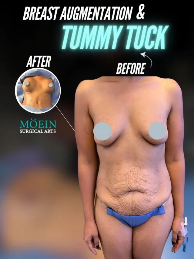 Breast Augmentation & Tummy Tuck Results ✨

Check out this stunning feminine transformation! With a combination of Breast Augmentation to enhance and restore volume and a Tummy Tuck to flatten and tighten the abdomen, this patient achieved a beautifully balanced and contoured figure.

💡 What Makes This Combo Powerful:

✔️ Breast Augmentation restores or enhances fullness and shape, creating natural-looking curves and improved body proportions.

✔️ Tummy Tuck (Abdominoplasty) removes excess skin and tightens the abdominal wall, achieving a slimmer, smoother, and more toned midsection.

The result? A confident new outlook with enhanced curves and a contoured waistline – combining fuller breasts with a flatter, firmer abdomen for a complete transformation!

Are you interested in Breast Augmentation, Tummy Tuck, or full body sculpting? Contact us today!

📲 DM us
📞 Call us (310) 861-4093
🌐 Visit www.moeinsurgicalarts.com

• • •
#BreastAugmentation #TummyTuck #BodyContouring #MommyMakeover #PlasticSurgery #BeforeAndAfter #drmoein #beverlyhills