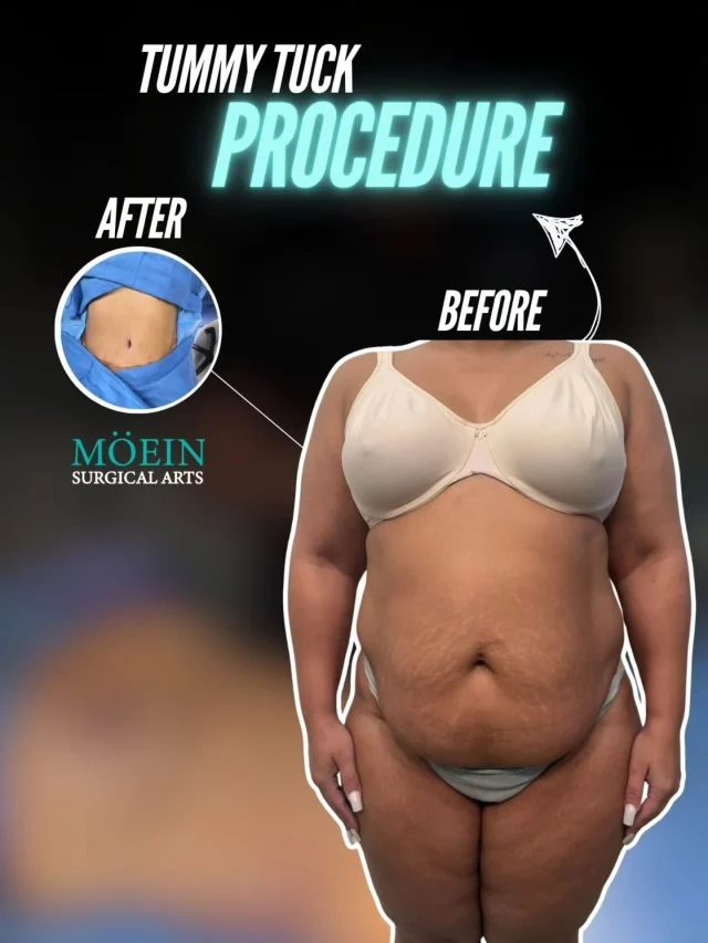Tummy Tuck Transformation ✨

Dr. Moein proudly showcases the stunning transformation achieved through a Tummy Tuck (Abdominoplasty) — designed to restore a flatter, firmer, and more sculpted abdominal contour. 💫

🌟 What this procedure accomplishes:
✅ Removes excess skin and stubborn fat
✅ Tightens weakened or separated abdominal muscles
✅ Enhances overall body proportions and posture

The result? A smoother, more youthful midsection and renewed self-confidence. With time, the incision lines will continue to fade beautifully, revealing a natural and balanced silhouette.

👨‍⚕️ At Moein Surgical Arts, we specialize in body contouring procedures that blend artistry with surgical precision, ensuring results that look as natural as they feel empowering.

📲 DM us to learn more about the Tummy Tuck procedure
📞 Call us: (310) 861-4093
🌐 Visit: www.moeinsurgicalarts.com

📧 Email: Appointment@msurgicalarts.com

#TummyTuck #Abdominoplasty #BodyContour #FlatStomach #DrMoein #MoeinSurgicalArts #ConfidenceBoost #PlasticSurgery #bodytransformation