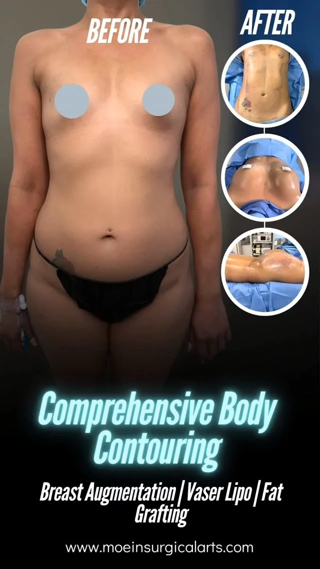 Comprehensive Body Contouring ✨

Breast Augmentation | Vaser Liposuction | Fat Grafting

Dr. Moein proudly presents a Complete Body Contouring Transformation — a combination of advanced techniques including Breast Augmentation, Vaser Liposuction, and Fat Grafting to sculpt, enhance, and redefine your natural curves with precision and artistry. 💫

🌟 What this comprehensive approach achieves:

✅ Restores youthful volume and shape to the breasts

✅ Eliminates stubborn fat deposits and refines body contours

✅ Utilizes fat grafting for smooth, natural enhancements

✅ Improves overall body balance, symmetry, and confidence

The result? A beautifully sculpted, harmonious silhouette that looks as natural as it feels empowering. Each procedure is customized to your unique anatomy, ensuring elegant, long-lasting results.

👨‍⚕️ At Moein Surgical Arts, we specialize in advanced body contouring solutions that merge surgical skill with artistic vision—helping you achieve the shape you’ve always desired.

📲 DM us to learn more about our comprehensive body contouring options

📞 Call: (310) 861-4093

🌐 Visit: www.moeinsurgicalarts.com

📧 Email: Appointment@msurgicalarts.com

#BodyContouring #BreastAugmentation #VaserLipo #FatGrafting #DrMoein #MoeinSurgicalArts #SculptedBody #ConfidenceBoost #PlasticSurgery #BodyTransformation