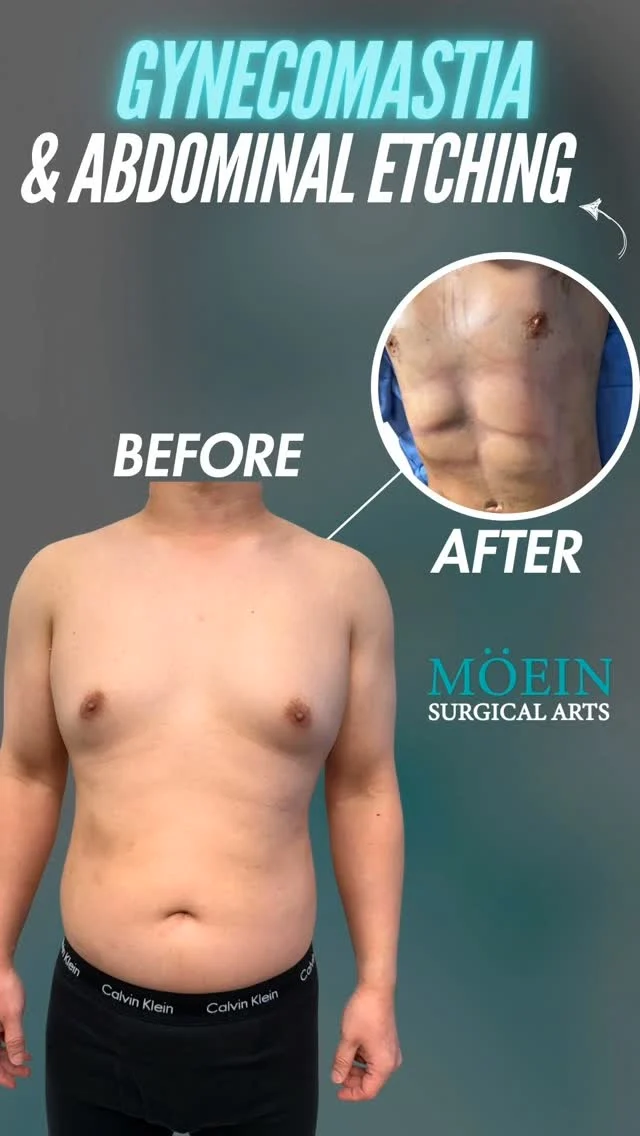 Gynecomastia & Abdominal Etching Transformation ✨

Male Chest Contouring | Precision Liposculpting | Definition Enhancement

Dr. Moein proudly presents a **Complete Male Body Transformation** — combining advanced **Gynecomastia Correction** and **Abdominal Etching** techniques to sculpt a masculine, athletic, and naturally defined physique with surgical precision. 💫

🌟 What this specialized approach achieves:

✅ Removes excess glandular tissue and stubborn chest fat
✅ Defines the chest and restores masculine contour
✅ Sculpts precise abdominal lines for a six-pack appearance
✅ Enhances overall body proportion, symmetry, and confidence

The result? A chiseled, confident, and sculpted male torso that looks naturally fit and refined. Each procedure is meticulously tailored to your body type, ensuring realistic, balanced, and long-lasting results.

👨‍⚕️ At Moein Surgical Arts, we specialize in advanced male body contouring  techniques that blend surgical expertise with aesthetic artistry—helping you achieve your ideal, confident shape.

📲 DM us to learn more about Gynecomastia Surgery & Abdominal Etching options

📞 Call: (310) 861-4093
🌐 Visit: [www.moeinsurgicalarts.com]
📧 Email: [Appointment@msurgicalarts.com]

#Gynecomastia #AbdominalEtching #MaleBodyContouring #ChestSculpting #SixPackSurgery #DrMoein #MoeinSurgicalArts #VaserLipo #ConfidenceBoost #BodyTransformation