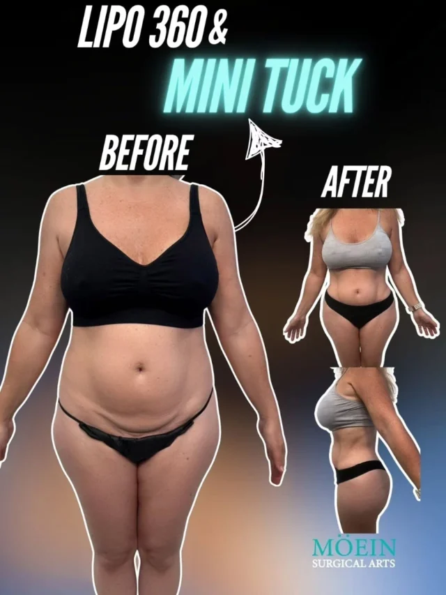 WIPE ➡️ to see this stunning Lipo 360 & Mini Tuck transformation! 💃

BEFORE:
😟 Stubborn belly and flank fat that wouldn’t go away with diet or workouts.
😟 Loose lower abdominal skin after weight changes or pregnancy.
😟 A waistline that lacked definition and contour.

AFTER:
😊 A smoother, flatter abdomen with tightened lower skin.
😊 Sculpted waist and midsection from every angle — front, sides, and back.
😊 A naturally contoured, confident silhouette that looks great in and out of clothes.

This Lipo 360 & Mini Tuck combo completely reshaped her core — removing excess fat, tightening skin, and defining curves for a beautifully balanced result. ✨

Ready to redefine your shape and confidence? Let’s talk!

📲 DM us
📞 Call us (310) 861-4093
🌐 Visit www.moeinsurgicalarts.com

📧 Appointment@msurgicalarts.com

•
•
#Lipo360 #MiniTuck #BodyContour #DrMoein #MoeinSurgicalArts #LosAngelesCosmeticSurgeon #TummyTuckResults #ConfidenceRestored #BodyGoals