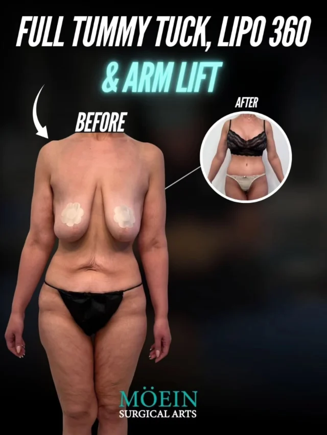 WIPE ➡️ to see this incredible Full Tummy Tuck, Arm Lift & Lipo 360 transformation! ✨💃

BEFORE:
😟 Loose abdominal skin + weakened muscles after weight changes or pregnancy
😟 Stubborn fat around the waist, flanks, and back that didn’t respond to diet or exercise
😟 Sagging or excess skin on the upper arms

AFTER:
😊 A tighter, flatter abdomen with restored core support
😊 Sculpted waistline and smooth contour all the way around — front, sides, and back
😊 Lifted, firmed arms with a more toned, youthful appearance

This Full Tummy Tuck + Arm Lift + Lipo 360 combo redefined her entire upper body — removing excess skin, tightening underlying structures, and enhancing curves for a naturally balanced, confident silhouette. ✨

Ready to reshape your body and reclaim your confidence?

Let’s talk. 💬

📲 DM us
📞 (310) 861-4093
🌐 www.moeinsurgicalarts.com

📧 Appointment@msurgicalarts.com

•
•
#FullTummyTuck #ArmLift #Lipo360 #BodyContour #DrMoein #MoeinSurgicalArts #CosmeticSurgery #ConfidenceRestored #BodyTransformation #LosAngelesCosmeticSurgeon