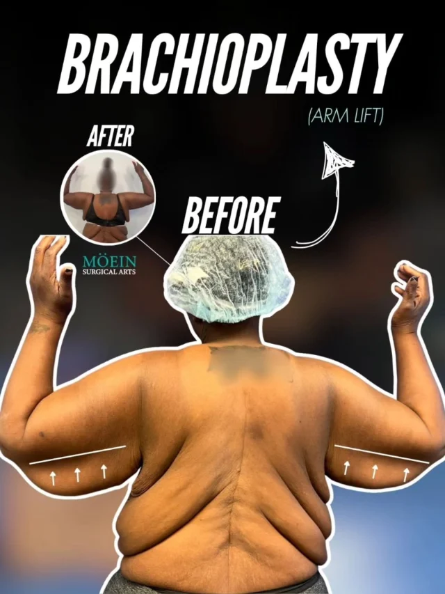 WIPE ➡️ to see this stunning Brachioplasty transformation! ✨💃

BEFORE:
😟 Sagging, loose skin on the upper arms (“bat wings”)
😟 Stubborn fat deposits that made the arms look heavy
😟 Loss of arm definition after weight changes or aging

AFTER:
😊 Smooth, firm, and beautifully contoured upper arms
😊 Excess skin removed for a tighter, more sculpted look
😊 Improved arm tone that enhances the silhouette and boosts confidence

This Brachioplasty (Arm Lift) reshaped her arms by removing excess skin, refining underlying tissues, and creating a naturally slimmer, more youthful contour. The result is balance, elegance, and confidence with every movement. ✨

Ready to transform your arms and reveal the shape you’ve always wanted?

Let’s talk. 💬

📲 DM us
📞 (310) 861-4093
🌐 www.moeinsurgicalarts.com

📧 Appointment@msurgicalarts.com

•
•
#Brachioplasty #ArmLift #BodyContour #DrMoein #MoeinSurgicalArts #CosmeticSurgery #ArmTransformation #ConfidenceRestored #losangelescosmeticsurgeon