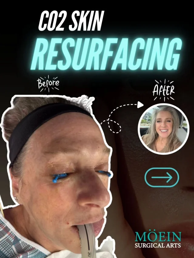 WIPE ➡️ to see this incredible CO₂ Skin Resurfacing Transformation! ✨🔥

BEFORE:
😟 Fine lines, wrinkles & early signs of aging
😟 Sun damage, uneven texture, and rough patches
😟 Acne scars and dull, lifeless skin tone

AFTER:
😊 Smoother, tighter, and more youthful-looking skin
😊 Dramatic improvement in texture, tone, and clarity
😊 Reduced wrinkles, minimized pores, and a radiant glow

This CO₂ Laser Skin Resurfacing treatment revitalizes the skin from deep within — removing damaged layers, stimulating collagen, and revealing a brighter, fresher, and more rejuvenated complexion. ✨

Ready to refresh your skin and restore your confidence?

Let’s talk. 💬

📲 DM us
📞 (310) 861-4093
🌐 www.moeinsurgicalarts.com
📧 Appointment@msurgicalarts.com

•
•
#CO2Laser #SkinResurfacing #LaserTreatment #AntiAging #SkinRejuvenation #SmoothSkin #RadiantGlow #DrMoein #MoeinSurgicalArts #CosmeticDermatology #SkinTransformation #ConfidenceRestored #LosAngelesCosmeticSurgeon