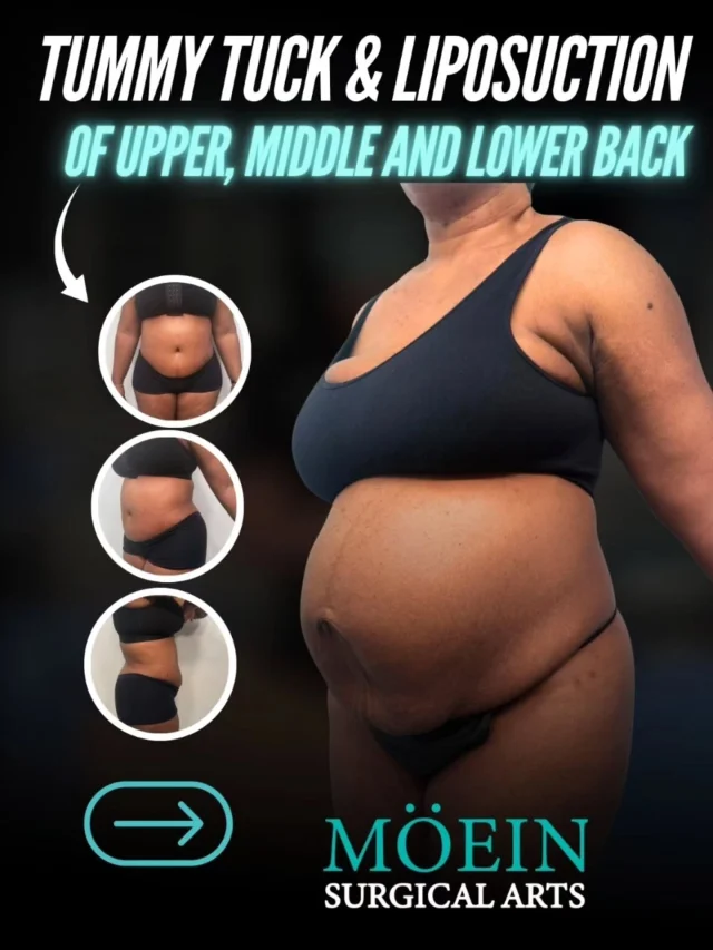 WIPE ➡️ to see this stunning Tummy Tuck & Back Liposuction transformation! ✨💃

BEFORE:
😟 Loose abdominal skin with weakened core muscles
😟 Stubborn fat across the upper, middle, and lower back
😟 Lack of waist definition due to excess fat and skin laxity

AFTER:
😊 A smooth, tight, and beautifully contoured abdomen
😊 Sculpted upper, middle & lower back for a sleek hourglass silhouette
😊 Restored core support with improved body shape and posture

This Tummy Tuck combined with Back Liposuction removed excess skin, tightened underlying muscles, and precisely sculpted the back to create a naturally balanced, slimmer, and more youthful figure. The result is confidence, symmetry, and a stunning shape from every angle. ✨

Ready to transform your midsection and reveal the silhouette you’ve always wanted?

Let’s talk. 💬

📲 DM us
📞 (310) 861-4093
🌐 www.moeinsurgicalarts.com
📧 Appointment@msurgicalarts.com

•
•
#TummyTuck #Lipo360 #BackLiposuction #BodyContour #DrMoein #MoeinSurgicalArts #Abdominoplasty #CosmeticSurgery #Transformation #ConfidenceRestored #losangelescosmeticsurgeon