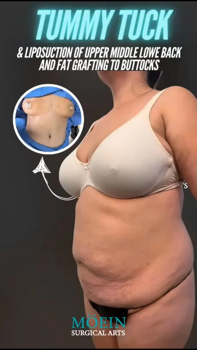 WIPE ➡️ to see this incredible Tummy Tuck, Back Liposuction & Buttock Fat Grafting transformation! ✨💃

BEFORE:
😟 Loose abdominal skin + weakened muscles after weight changes or pregnancy
😟 Stubborn fat across the upper, middle, and lower back
😟 Lack of volume and shape in the buttocks

AFTER:
😊 A tighter, flatter abdomen with restored core support
😊 Smoothly sculpted upper, middle & lower back for a 360° refined contour
😊 Fuller, rounder, and naturally enhanced buttocks through precise fat grafting

This Tummy Tuck + Back Liposuction + Buttock Fat Grafting combo reshaped her entire torso — removing excess skin, contouring every angle of the back, and enhancing curves for a balanced, confident silhouette. ✨

Ready to transform your shape and elevate your confidence?

Let’s talk. 💬

📲 DM us
📞 (310) 861-4093
🌐 www.moeinsurgicalarts.com

📧 Appointment@msurgicalarts.com

•
•
#TummyTuck #BackLiposuction #FatGrafting #BBL #BodyContour #DrMoein #MoeinSurgicalArts #CosmeticSurgery #BodyTransformation #ConfidenceRestored #LosAngelesCosmeticSurgeon