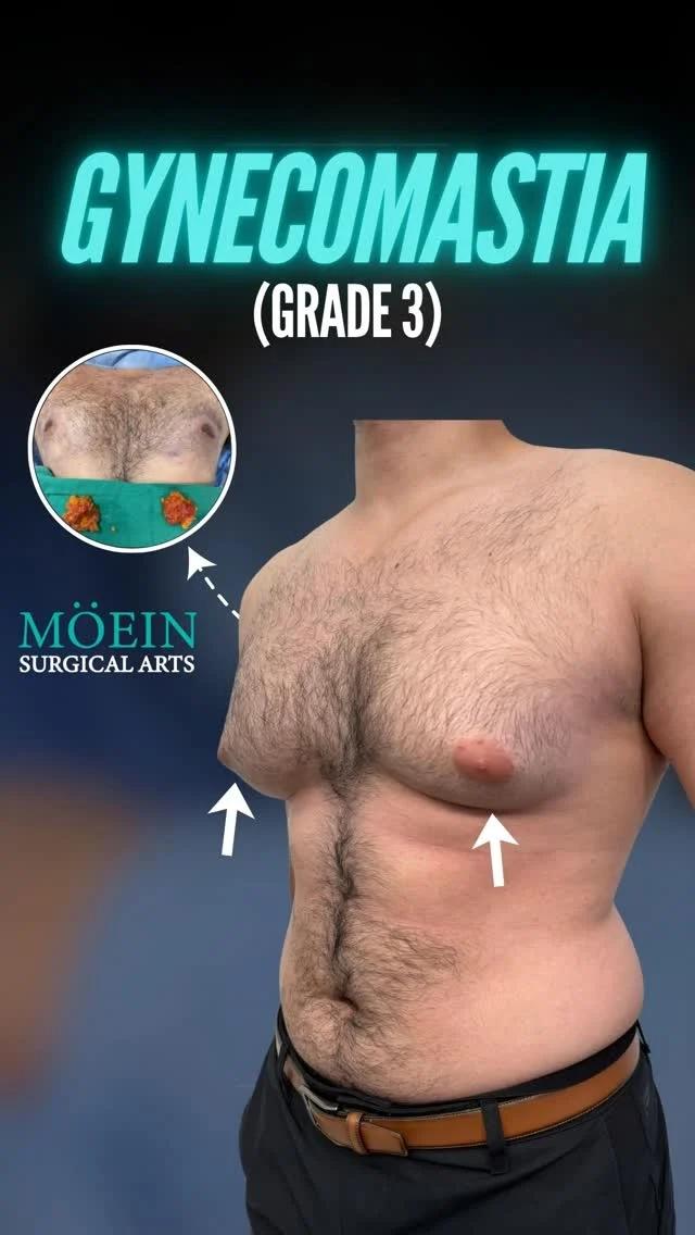 Comprehensive Gynecomastia Correction ✨

Grade 3 Gynecomastia Surgery | Gland Excision | Vaser Liposuction

Dr. Moein proudly presents a Complete Chest Transformation — a specialized approach for Grade 3 Gynecomastia that combines precise gland removal, advanced Vaser Liposuction, and skin reshaping to restore a strong, masculine chest contour. 💪🔥
🌟 What this comprehensive approach achieves:
✅ Removes enlarged glandular tissue causing excessive chest fullness
✅ Eliminates stubborn fat deposits for sharp, sculpted definition
✅ Tightens and reshapes the chest for a flatter, more athletic look
✅ Restores confidence, posture, and comfort in clothing and workouts

The result? A naturally masculine, contoured chest that looks balanced, firm, and empowering. Every procedure is custom-planned to fit your anatomy, ensuring smooth, long-lasting results with minimal scarring.

👨‍⚕️ At Moein Surgical Arts, we specialize in advanced gynecomastia correction techniques—combining surgical skill with aesthetic precision to help you regain the chest and confidence you deserve.

📲 DM us to learn more about Grade 3 Gynecomastia Surgery
 📞 Call: (310) 861-4093
 🌐 Visit: www.moeinsurgicalarts.com
 📧 Email: Appointment@msurgicalarts.com

#Gynecomastia #Grade3Gynecomastia #MaleChestSurgery #ChestSculpting #VaserLipo #DrMoein #MoeinSurgicalArts #ConfidenceRestored #MaleAesthetics #BodyTransformation