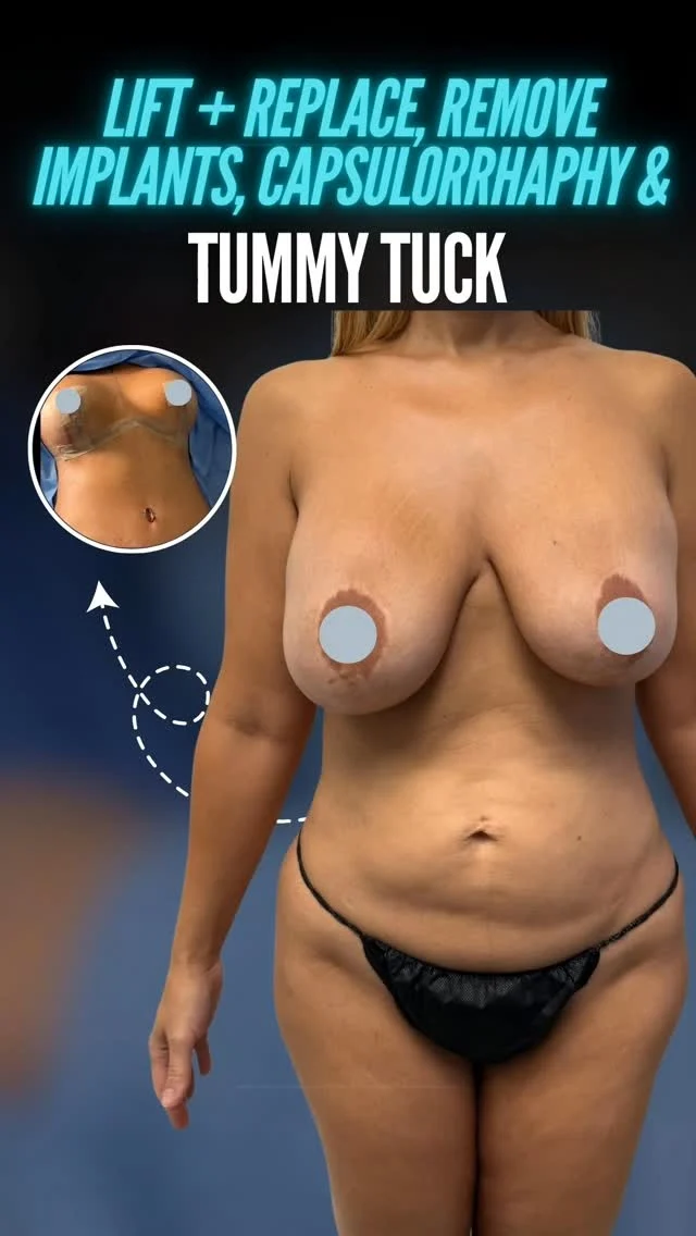 Lift + Replace | Implant Removal | Capsularrophy | Tummy Tuck ✨

Breast Revision & Abdominal Contouring | Precision Surgery | Natural Definition

Dr. Moein proudly presents a Comprehensive Body Transformation — combining advanced Breast Lift with Implant Replacement or Removal, Capsularrophy correction, and Tummy Tuck surgery to restore balance, comfort, and a naturally contoured silhouette with surgical precision. 💫

🌟 What this customized approach achieves:

✅ Lifts and reshapes the breasts for a youthful, supported contour

 ✅ Replaces or removes implants based on aesthetic and medical needs

 ✅ Treats capsularrophy to improve comfort and implant positioning

 ✅ Tightens abdominal muscles and removes excess skin

 ✅ Enhances overall body harmony, proportion, and confidence.

👨‍⚕️ At Moein Surgical Arts, we specialize in advanced breast revision and body contouring procedures—where surgical expertise meets aesthetic artistry.

📲 DM us to learn more about Breast Revision Surgery & Tummy Tuck options

📞 Call: (310) 861-4093

 🌐 Visit: www.moeinsurgicalarts.com

 📧 Email: Appointment@msurgicalarts.com

#BreastLift #ImplantRemoval #ImplantReplacement #Capsularrophy #TummyTuck #BreastRevision #DrMoein #MoeinSurgicalArts #BodyContouring #ConfidenceRestored #BodyTransformation