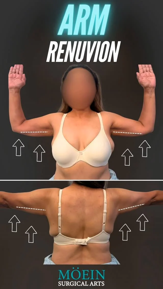 Arm Renuvion Skin Tightening Transformation! ✨💪

BEFORE:
😟 Loose, sagging upper arm skin (“bat wings”)
😟 Loss of firmness after weight changes or aging
😟 Poor arm definition that limited confidence in sleeveless wear

AFTER:
😊 Noticeably tighter, firmer upper arms
😊 Improved skin contraction and smooth texture
😊 Enhanced arm contour with a more youthful, toned appearance

Ready to tighten, tone, and redefine your arms?

Let’s talk. 💬

📲 DM us
📞 (310) 861-4093
🌐&nbsp;www.moeinsurgicalarts.com
📧&nbsp;Appointment@msurgicalarts.com

•
•
ArmRenuvion RenuvionJPlasma ArmTightening SkinTightening BodyContour DrMoein
