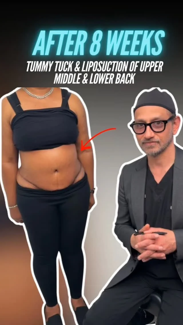 Tummy Tuck & Back Liposuction Transformation! ✨💃

BEFORE:
😟 Loose abdominal skin with weakened core muscles
😟 Stubborn fat across the upper, middle, and lower back
😟 Lack of waist definition due to excess fat and skin laxity

AFTER (8 weeks post-op):
😊 A smooth, tight, and beautifully contoured abdomen
😊 Sculpted upper, middle & lower back for a sleek hourglass silhouette
😊 Restored core support with improved body shape and posture

This&nbsp;After 8 weeks post-op of Tummy Tuck and Back Liposuction transformation&nbsp;showcases beautifully healed results with excess skin removed, muscles tightened, and the back precisely sculpted to create a naturally balanced, slimmer, and more youthful figure. The result is confidence, symmetry, and a stunning shape from every angle. ✨

Ready to transform your midsection and reveal the silhouette you’ve always wanted?

Let’s talk. 💬

📲 DM us
📞 (310) 861-4093
🌐&nbsp;www.moeinsurgicalarts.com