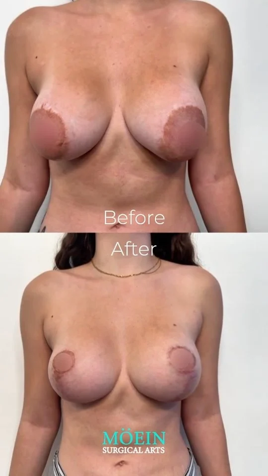 Breast Lift & Areola Reduction Transformation ✨

Designed to restore youthful breast position, improved symmetry, and natural proportions.
Concerns Addressed:
• Breast sagging caused by aging, pregnancy, or weight changes
• Enlarged or stretched areolas
• Loss of upper-pole fullness and definition

Results Achieved:
• Lifted, firmer, and beautifully contoured breasts
• Refined areola size for balanced proportions
• A youthful, natural-looking silhouette

This customized Breast Lift with Areola Reduction enhances shape while maintaining elegance and harmony with your body.
Confidence starts with feeling comfortable in your own skin.

📲 DM us to learn more
📞 (310) 861-4093
🌐 www.moeinsurgicalarts.com
📧 Appointment@msurgicalarts.com

#BreastLift #Mastopexy #AreolaReduction #DrMoein #MoeinSurgicalArts #NaturalResults #CosmeticSurgery #LosAngelesSurgeon