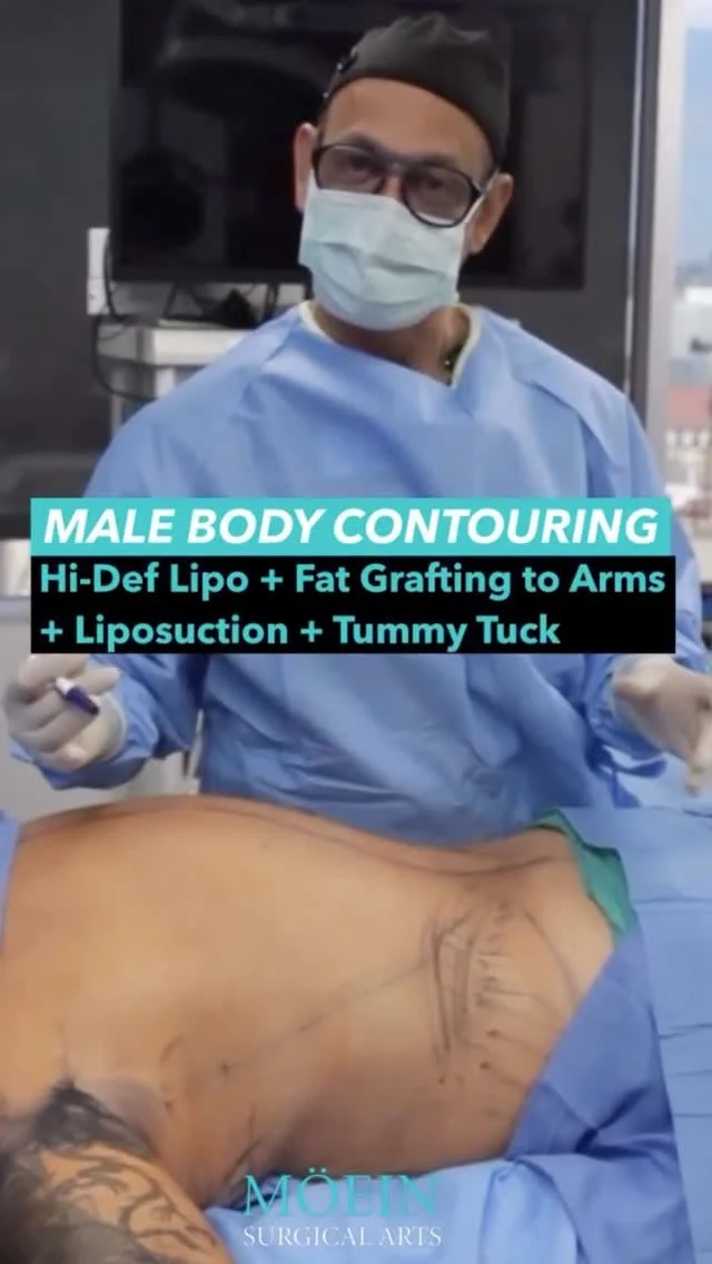 Total Redefinition: HD Lipo + Gynecomastia + Tummy Tuck + Fat Grafting to Arms

This patient was looking for more than fat reduction — they wanted a complete aesthetic upgrade. Through a customized combination of advanced procedures, we reshaped, refined, and rebalanced the entire physique.

✨ Treatment highlights:
• High-definition liposuction to sculpt the abdomen and back for full 360° contour
• Gynecomastia correction to restore a flatter, more defined male chest
• Strategic fat transfer to the arms to improve muscle definition and upper-body proportion
• Abdominoplasty to remove excess skin and tighten the core for a firm, athletic finish

The outcome: Sharper lines, improved symmetry, and a powerful, natural-looking physique — visible immediately.
This is where surgical precision meets artistic vision.

📲 Book your consultation today
📞 (310) 861-3176
🌐 moeinsurgicalarts.com