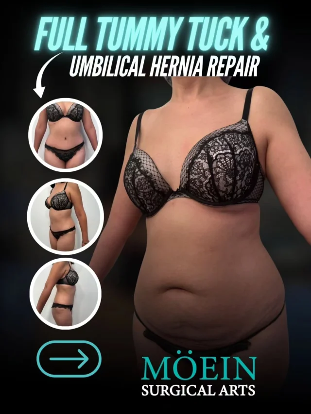 SWIPE ➡️ to see this powerful Full Tummy Tuck & Umbilical Hernia Repair transformation! ✨🔥

BEFORE:
😟 Loose, hanging abdominal skin after weight changes or pregnancy
😟 Weakened abdominal muscles causing a bulging midsection
😟 Umbilical hernia affecting comfort, posture, and core strength
😟 Lack of a smooth, firm abdominal contour

AFTER:
😊 Tight, flat, and beautifully contoured abdomen
😊 Repaired umbilical hernia with restored core stability
😊 Strengthened abdominal muscles for improved function and support
😊 A smoother, more defined waistline with a confident silhouette

This Full Tummy Tuck combined with Umbilical Hernia Repair was carefully designed to restore both form and function by tightening weakened muscles, removing excess skin, and repairing the hernia for long-term stability. The result is a flatter, stronger, and more confident abdomen with natural-looking contours. ✨

Ready to restore your core and reveal a smoother, firmer midsection?

Let’s talk. 💬
📲 DM us
📞 (310) 861-4093
🌐 moeinsurgicalarts.com
📧 Appointment@msurgicalarts.com
•
•
#TummyTuck #UmbilicalHerniaRepair #AbdominalReconstruction #BodyContouring #DrMoein MoeinSurgicalArts CoreRestoration FlatStomach ConfidenceRedefined LosAngelesCosmeticSurgeon
