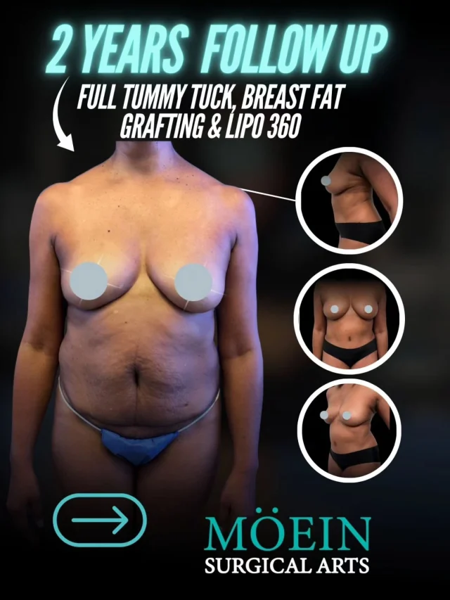 WIPE ➡️ to see this incredible 2-Year Follow-Up Transformation ✨💃

Procedure: Full Tummy Tuck, Breast Fat Grafting & Lipo 360

BEFORE:
😟 Loose abdominal skin with stretched muscles after weight changes
😟 Loss of breast volume and upper pole fullness
😟 Stubborn fat around the abdomen, flanks, and back creating a boxy shape

AFTER – 2 YEARS LATER:
😊 A firm, flat abdomen with long-lasting muscle repair
😊 Naturally enhanced breast volume using your own fat
😊 Beautifully sculpted waistline from Lipo 360 for a balanced, hourglass silhouette
😊 Maintained results that still look smooth, natural, and proportional

This transformation included a Full Tummy Tuck to remove excess skin and tighten the abdominal muscles, Lipo 360 to contour the entire midsection (front, sides, and back), and Breast Fat Grafting to restore soft, natural fullness without implants.

Two years later, the results remain strong, sculpted, and beautifully refined — proving that with expert technique and proper aftercare, outcomes can be long-lasting and natural-looking. ✨

Ready to invest in a transformation that stands the test of time?

Let’s talk. 💬

📲 DM us
📞 (310) 861-4093
🌐 www.moeinsurgicalarts.com

📧 Appointment@msurgicalarts.com

#drmoein #beverlyhills  #tummytuck #moeinsurgialarts