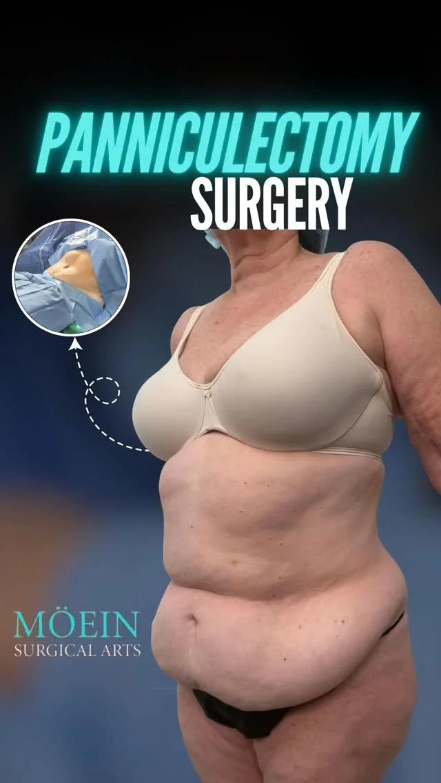 Panniculectomy Surgery Transformation ✨

Designed to remove excess abdominal skin and restore comfort, mobility, and natural body contours.
Concerns Addressed:
• Excess hanging abdominal skin after major weight loss
• Skin irritation, rashes, or hygiene difficulties beneath the pannus
• Discomfort during movement and daily activities
• Lower abdominal heaviness affecting posture and confidence

Results Achieved:
• Removal of excess overhanging skin and tissue
• Improved abdominal contour and smoother silhouette
• Reduced skin irritation and improved hygiene
• Enhanced comfort and freedom of movement

Confidence starts with feeling comfortable in your own body.

📲 DM us to learn more
📞 (310) 861-4093
🌐 moeinsurgicalarts.com
📧 Appointment@msurgicalarts.com

#Panniculectomy #BodyContouring #DrMoein #MoeinSurgicalArts #LosAngelesSurgeon