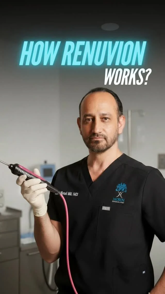 How Does Renuvion Work?

In this video, Dr. Moein explains how Renuvion technology tightens and rejuvenates the skin using advanced helium plasma and radiofrequency energy for smoother, firmer results.

Watch as Dr. Moein discusses how Renuvion:

• Uses a unique combination of radiofrequency (RF) energy and helium plasma

 • Precisely heats the tissue beneath the skin to stimulate collagen production

 • Creates immediate skin contraction with long-term tightening benefits

✨ This video is designed to help you understand how Renuvion works, who it’s best for, and what kind of results you can realistically expect.

📲 DM “RENUVION” to learn more or schedule your private consultation.