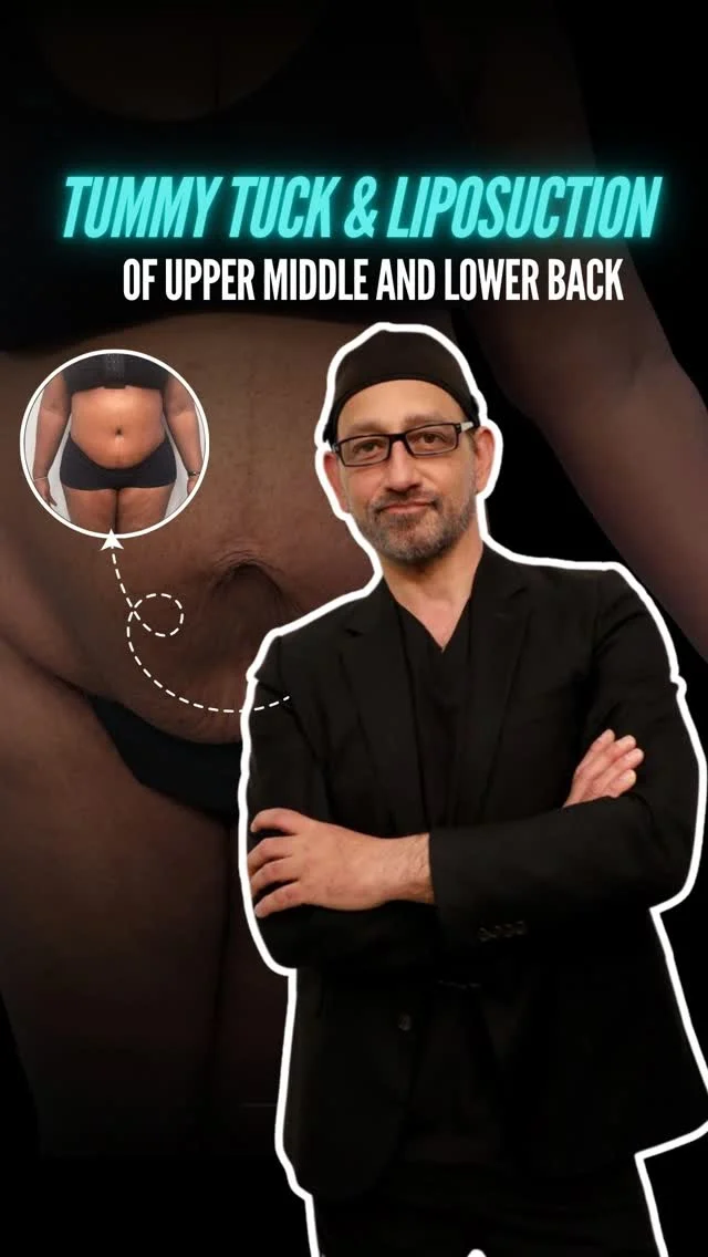 Tummy Tuck & Back Liposuction – Understanding Rectus Diastasis✨

A Tummy Tuck (Abdominoplasty) combined with liposuction of the upper, middle, and lower back is a comprehensive approach designed to restore abdominal firmness and improve full torso contour.

Dr. Moein often explains that many patients — especially after pregnancy or significant weight changes — develop Rectus Diastasis, a condition where the abdominal muscles separate and weaken. This separation can cause:
• A persistent lower belly bulge
• Core weakness
• Poor posture
• Difficulty achieving a flat abdomen despite diet and exercise

✨ How This Procedure Helps
✔️ Tummy Tuck tightens separated abdominal muscles (repairing Rectus Diastasis)
✔️ Removes excess skin and loose tissue
✔️ Liposuction of the upper, middle, and lower back enhances waist definition
✔️ Creates a smoother, more sculpted 360° contour

By repairing the abdominal wall and refining the back contour at the same time, patients achieve a more balanced, natural-looking silhouette.
This approach is not just about removing excess skin or fat — it’s about restoring structure, strength, and confidence.

📲 Send us a message to learn if you are a candidate
📞 (310) 861-3176
🌐 moeinsurgicalarts.com
📧 appointment@msurgicalarts.com