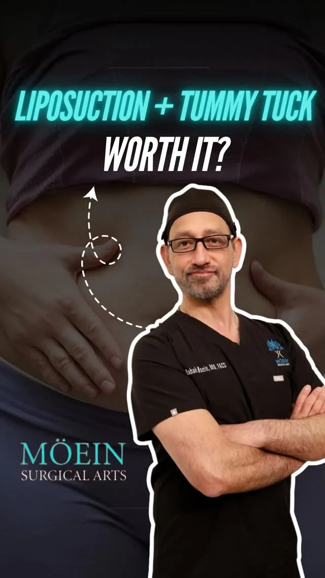 Is Adding Liposuction with Tummy Tuck Really Worth It?

In this video, Dr. Moein explains whether combining liposuction with a tummy tuck is truly worth it and how this powerful combination can enhance body contouring results.

Watch as Dr. Moein discusses how combining these procedures:
• Helps remove stubborn fat while tightening loose abdominal skin
 • Enhances overall body contour for a more sculpted and balanced look
 • Can improve waist definition and create smoother results
 • May deliver more comprehensive results compared to a tummy tuck alone

✨ This video is designed to help you understand when combining liposuction with a tummy tuck makes sense, who is the ideal candidate, and what kind of results you can realistically expect.

📲 DM “TUMMY” to learn more or schedule your private consultation.