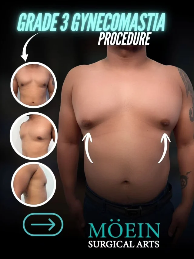 Grade 3 Gynecomastia Transformation! ✨💪

BEFORE:
😟 Severe chest enlargement with excess glandular tissue and fat
😟 Significant loose, sagging skin (Grade 3 gynecomastia)
😟 Feminized chest appearance affecting confidence and clothing choices

AFTER:
😊 Flat, firm, masculine chest contour
😊 Excess skin removed with improved chest tightness
😊 Sculpted, natural-looking definition for a stronger upper body appearance

This Grade 3 Gynecomastia Surgery involved advanced gland removal, liposuction, and skin tightening — addressing both excess tissue and loose skin to fully restore a masculine chest contour and confidence. ✨

Ready to reclaim your confidence and transform your chest?

Let’s talk. 💬

📲 DM us
📞 (310) 861-4093
🌐 moeinsurgicalarts.com
📧 Appointment@msurgicalarts.com

•
•
#Gynecomastia #Grade3Gynecomastia #MaleChestSurgery #ChestContouring