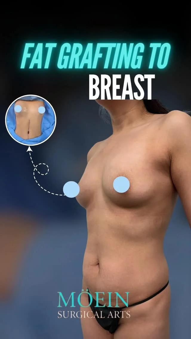 ✨🔥 Fat Grafting to Breast Transformation!

BEFORE:
😟 Loss of breast volume or fullness
😟 Asymmetry affecting overall balance
😟 Desire for a more natural enhancement

AFTER:
😊 Fuller, naturally enhanced breast shape
😊 Improved symmetry and soft contours
😊 Subtle, balanced, and more youthful appearance
Fat Grafting to the Breast uses your body’s own fat to enhance volume and shape—creating natural-looking results without implants.
Ready to enhance your curves naturally and restore your confidence?

Let’s talk. 💬
📲 DM us
📞 (310) 861-4093
🌐 moeinsurgicalarts.com
📧 Appointment@msurgicalarts.com
•
•
#FatGrafting #BreastEnhancement #NaturalResults #drmoein #moeinsurgicalarts