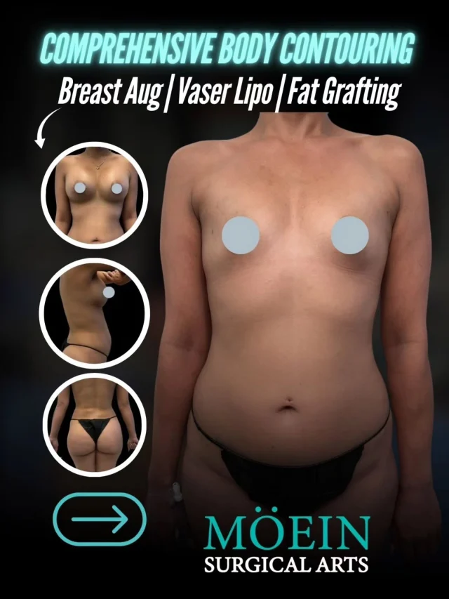 Comprehensive Body Contouring Transformation! ✨💪
Breast Aug | Vaser Lipo | Fat Grafting 

BEFORE:
😟 Stubborn fat deposits resistant to diet and exercise
😟 Lack of body definition and contour in key areas
😟 Volume loss or imbalance affecting overall body proportions

AFTER:
😊 Sculpted, well-defined body contours with enhanced shape
😊 Targeted fat removal for a slimmer, more refined silhouette
😊 Restored volume and natural curves through fat grafting and breast enhancement

This transformation included Comprehensive Body Contouring with Breast Augmentation, VASER Liposuction, and Fat Grafting — combining advanced fat removal and volume enhancement techniques to sculpt, contour, and create a balanced, natural-looking physique. ✨

Ready to enhance your shape and confidence?

Let’s talk. 💬

📲 DM us
📞 (310) 861-4093
🌐 moeinsurgicalarts.com
📧 Appointment@msurgicalarts.com

•
•
#BodyContouring #BreastAugmentation #VaserLipo #FatGrafting #bodytransformation