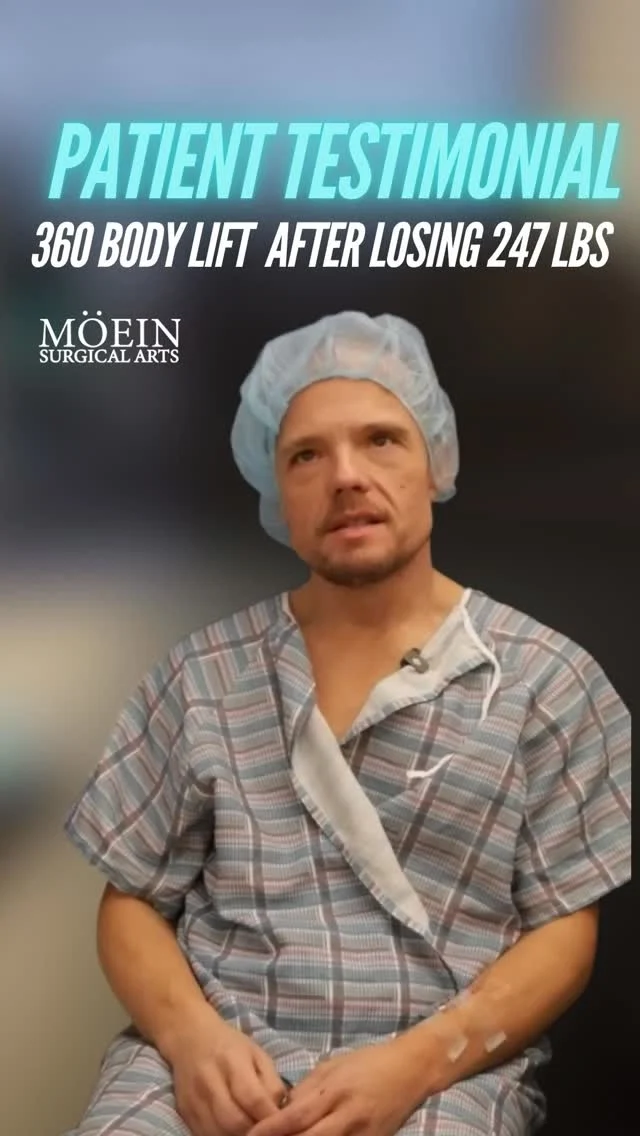 This 41-year-old patient lost over 100 pounds following a gastric sleeve procedure, along with additional weight through dedication, discipline, and lifestyle changes. While the number on the scale changed dramatically, excess skin remained—impacting his confidence, comfort, and the way he experienced everyday life.

Today marks the next chapter of his journey.
He is undergoing a 360 body lift, a comprehensive procedure designed to remove excess skin from the abdomen, back, and waist. The goal is not just to tighten the body, but to restore natural contours, improve mobility, and help align his physical appearance with the hard work he has already put in.
Post-weight loss transformation is never one-size-fits-all. Each case requires careful planning, surgical precision, and a deep understanding of how to achieve balanced, natural-looking results.

Because in the end, this isn’t just about how you look—
 it’s about how you feel.
Confidence. Comfort. Freedom.
 Finally feeling at home in your own body.

📲 Send us a message to book your consultation
 🌐 moeinsurgicalarts.com

#drmoein #bodytransformation #bodylift #weightlossjourney #confidence